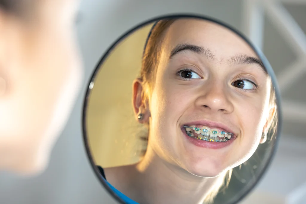 Dental Braces: Everything You Need to Know