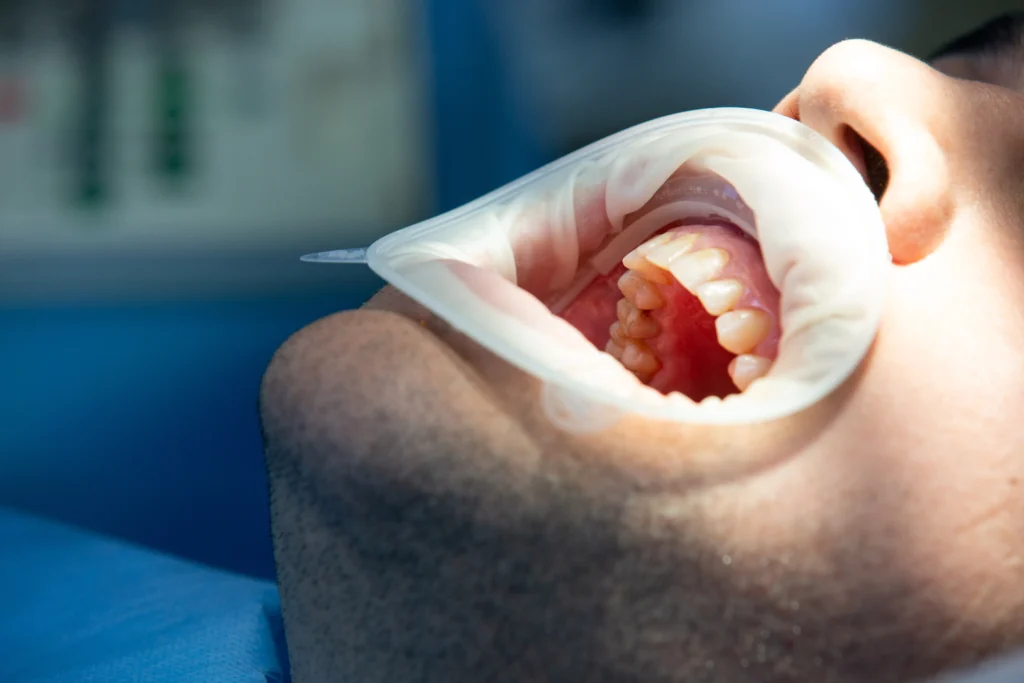 Oral Precancer: Warning Signs Every Adult Should Know in 2026