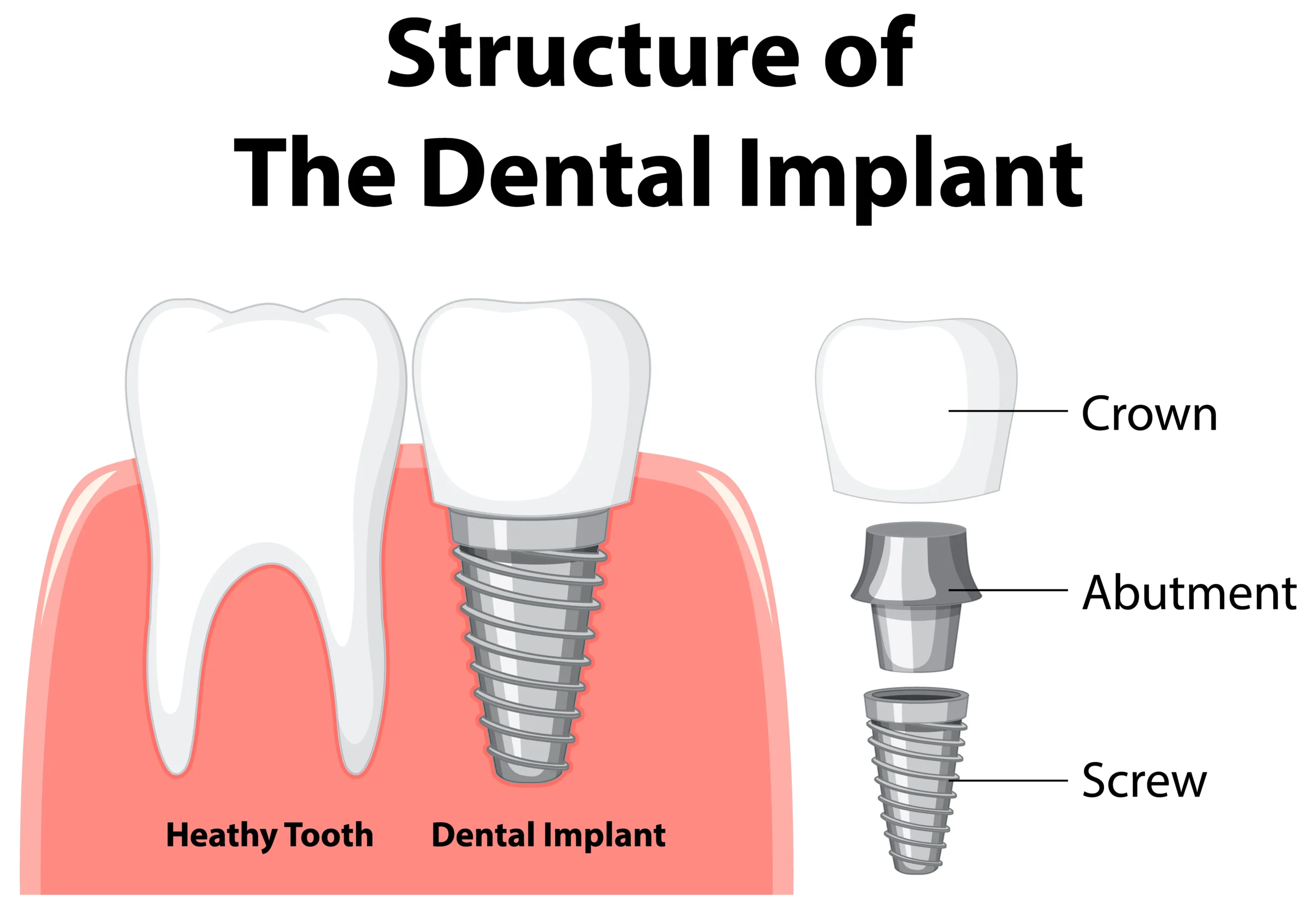 dental implant