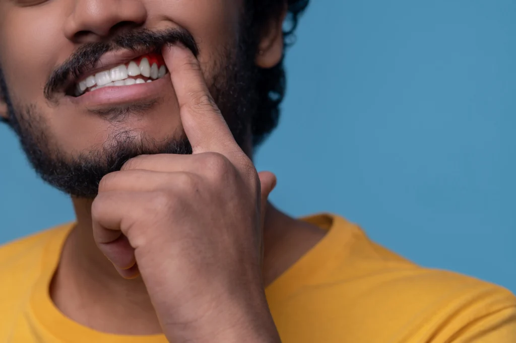 Bleeding Gums While Brushing: Is It Normal or a Sign of Gum Disease?