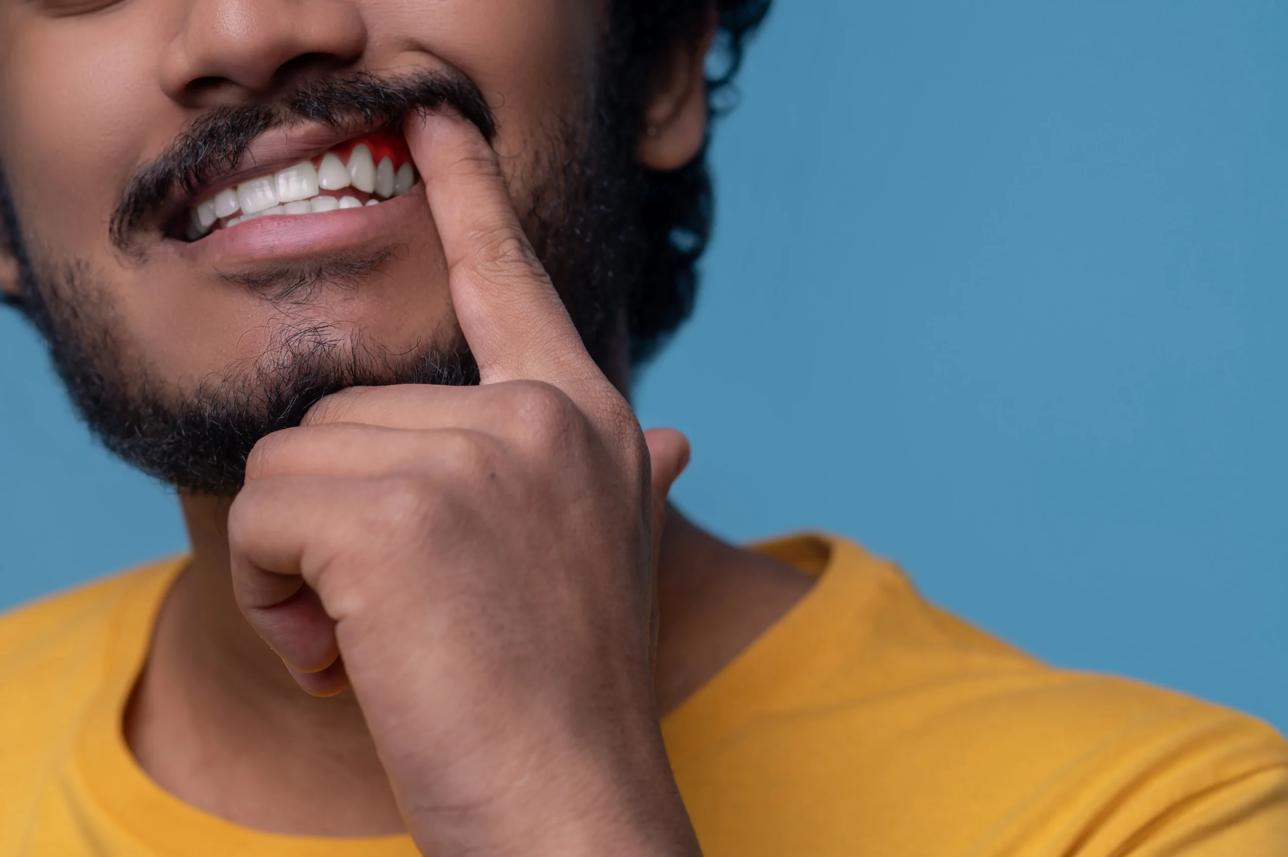 bleeding gums