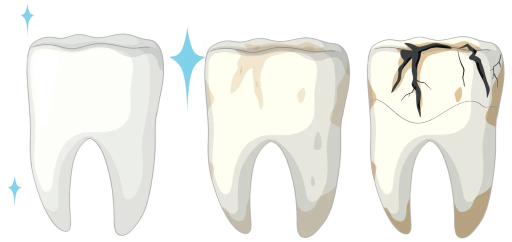 Cracked Tooth: Crown vs Root Canal vs Extraction-Which Treatment Do You Need?