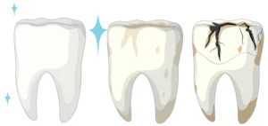 cracked tooth