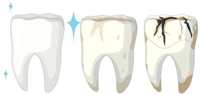 cracked tooth